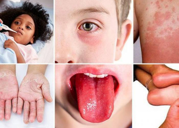 Uşaqlarda multisistemli iltihab sindromu - İnfeksiiyalardan sonra baş qaldırır